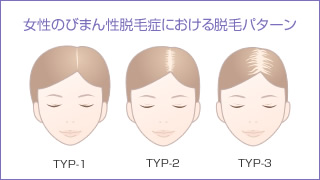 びまん性脱毛症のイメージ