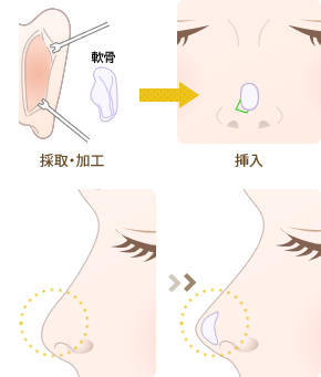 耳介軟骨移植