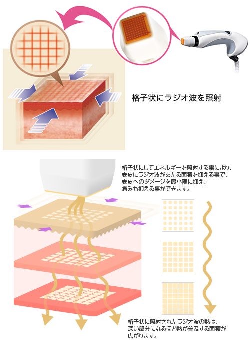 イントラジェンの仕組み