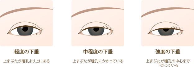眼険下垂重症度