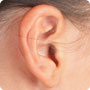 耳垂粉瘤・耳垂ケロイド・副耳