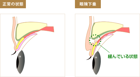 眼険下垂の仕組み