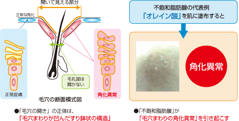 毛穴の断面模式図