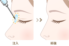 ヒアルロン酸注入の隆鼻術