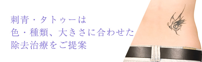 刺青・タトゥーは色・種類、大きさに合わせた除去治療をご提案